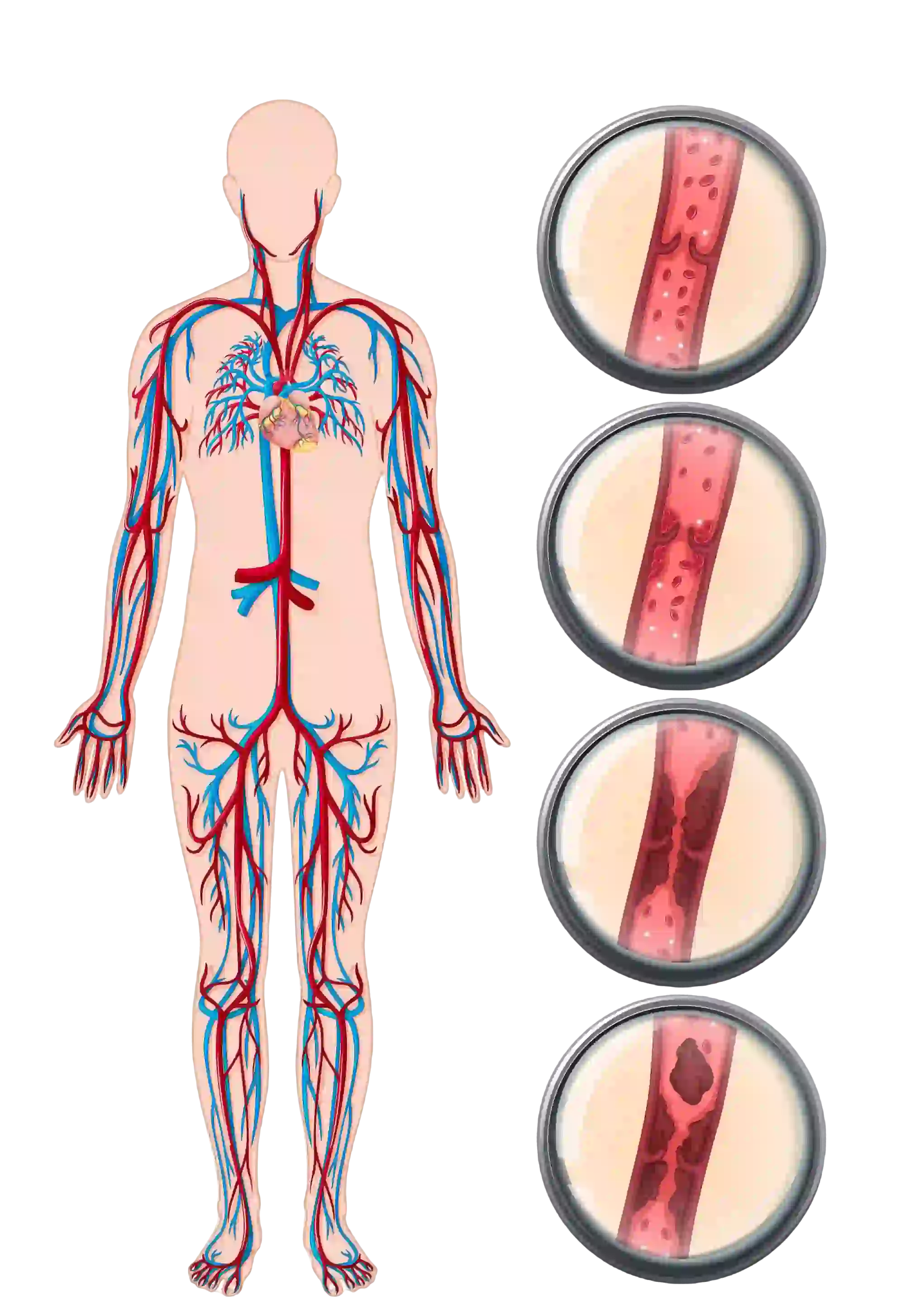 Deep Vein Thrombosis Illustration