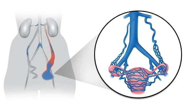Pelvic Congestion Syndrome Illustration