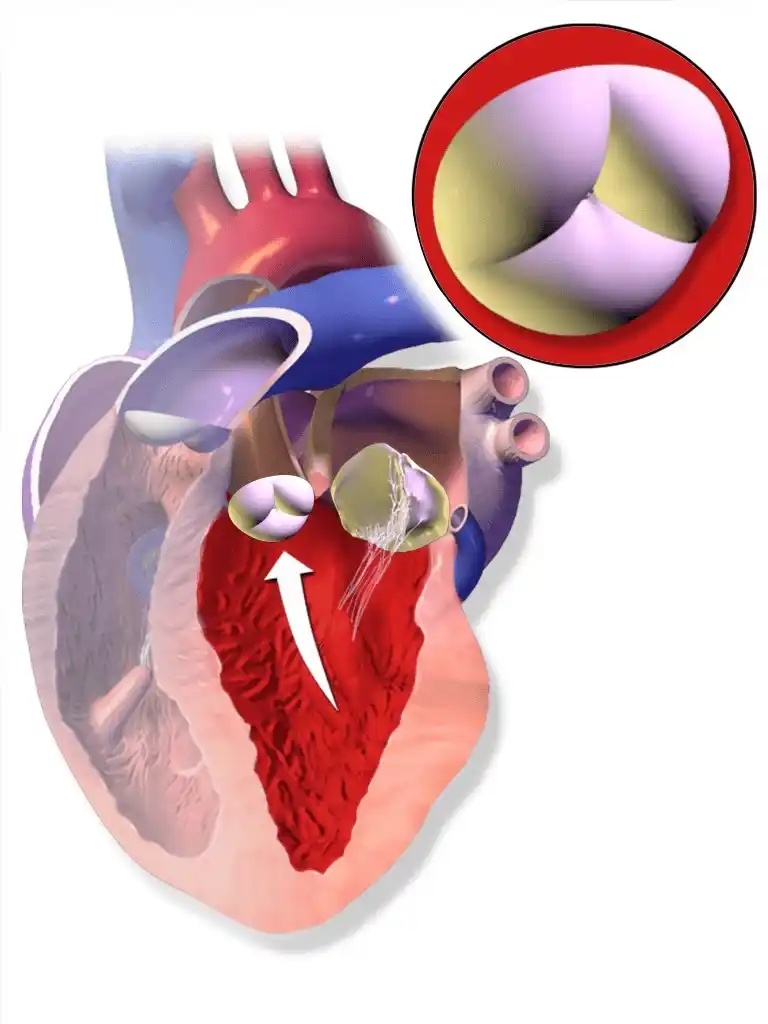 Aortic Stenosis Illustration