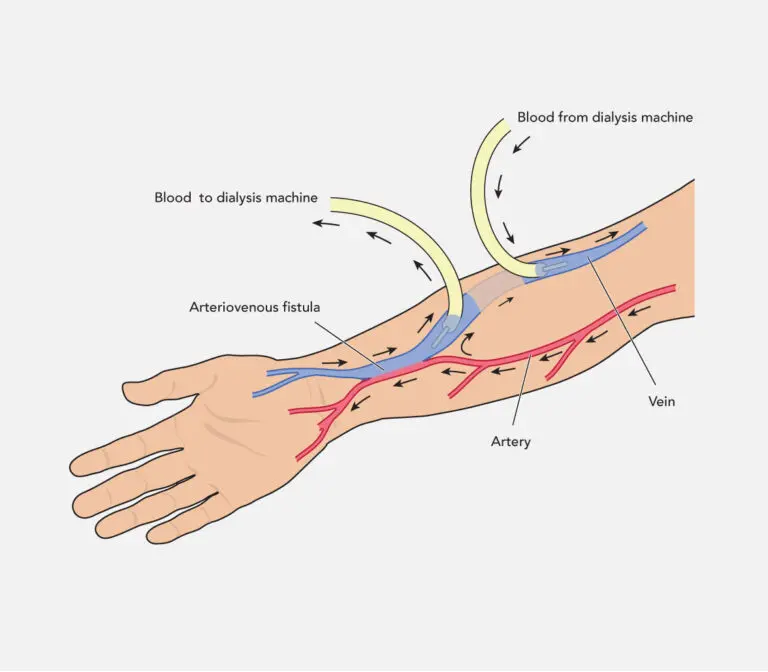 Arteriovenous Fistula Illustration