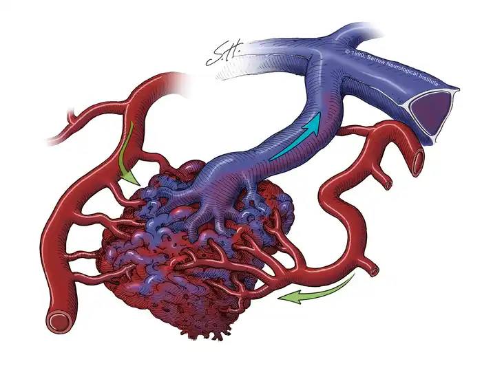 Arteriovenous Malformation Illustration