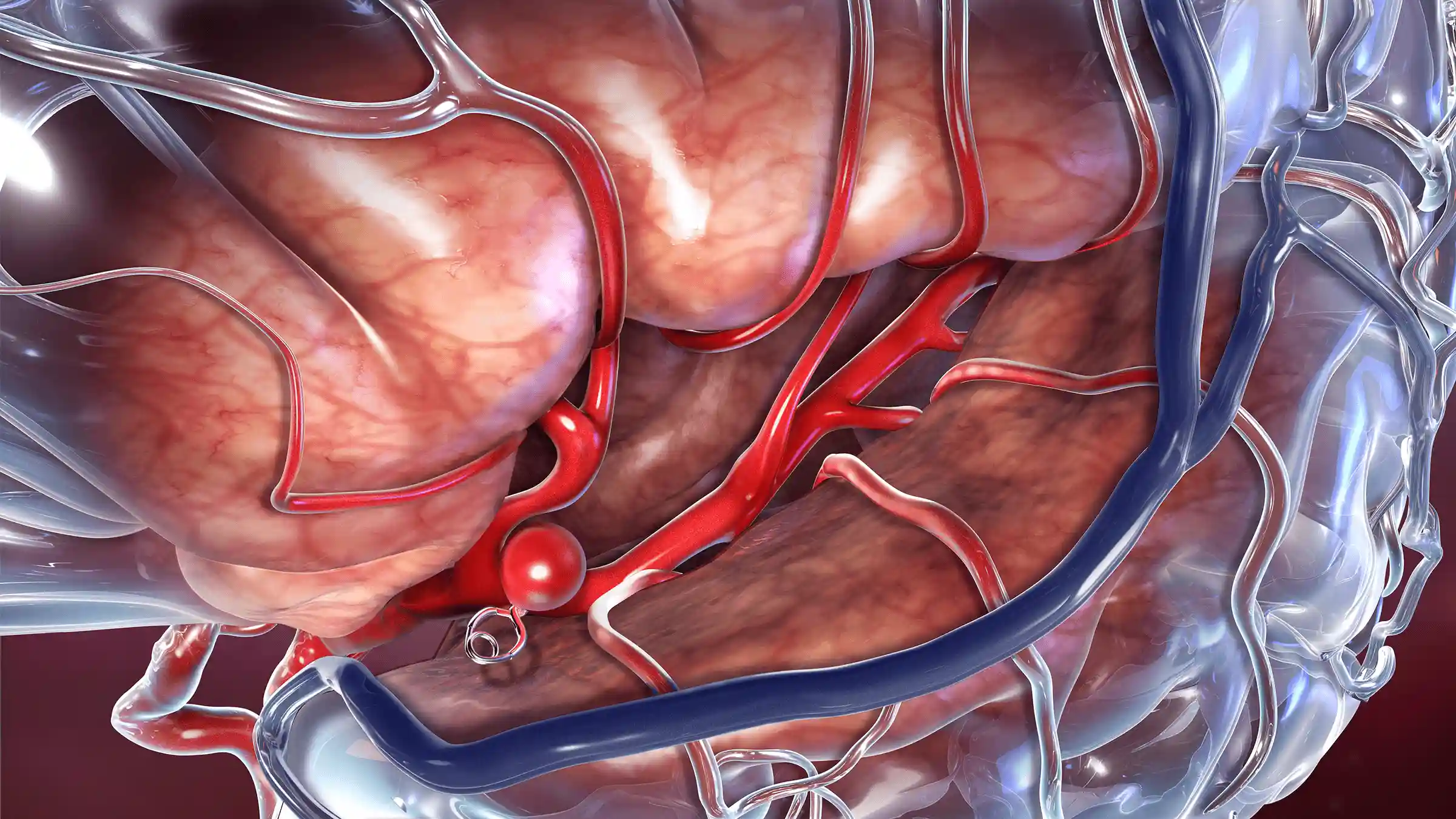 Brain Aneurysm Illustration