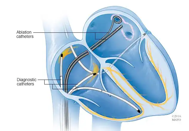 Cardiac Ablation Illustration