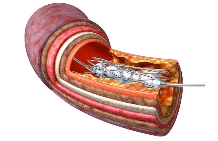 Chemoembolization Illustration