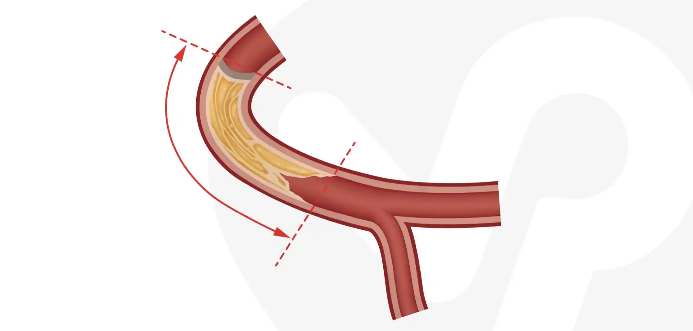 Chronic Total Occlusion Illustration