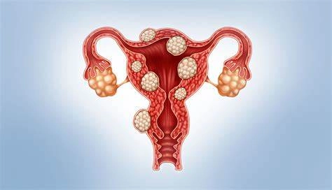Fibroid Embolization Illustration