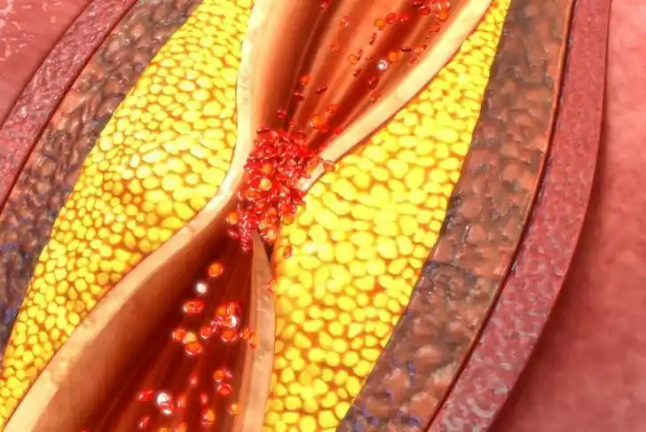 Leriche Syndrome Illustration