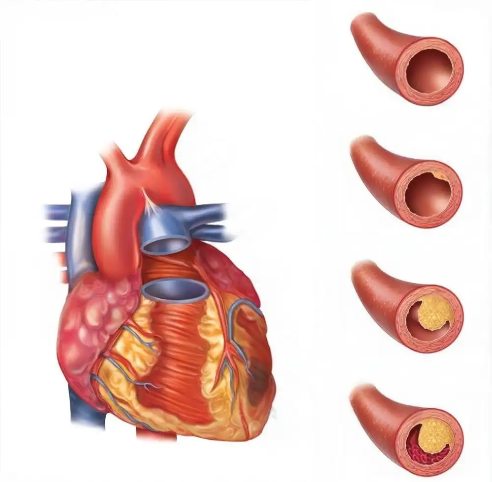 Myocardial Infarction Illustration