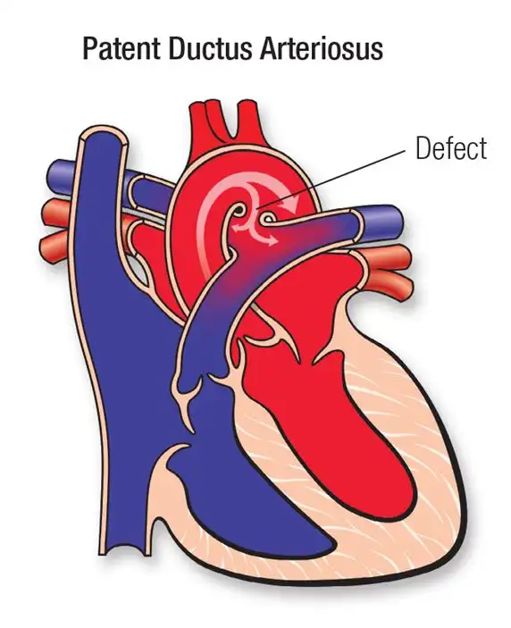 Patent Ductus Arteriosus Illustration