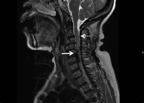 Spinal AVM Illustration