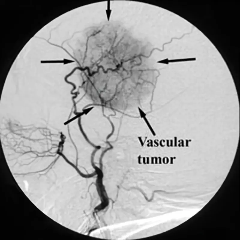 Tumor Embolization Illustration
