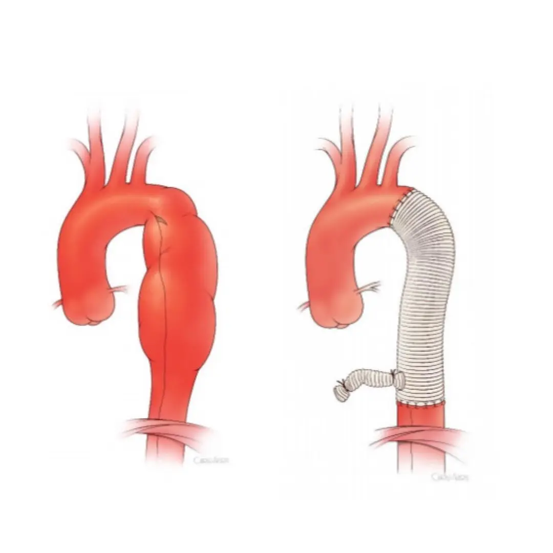 TVAR Illustration