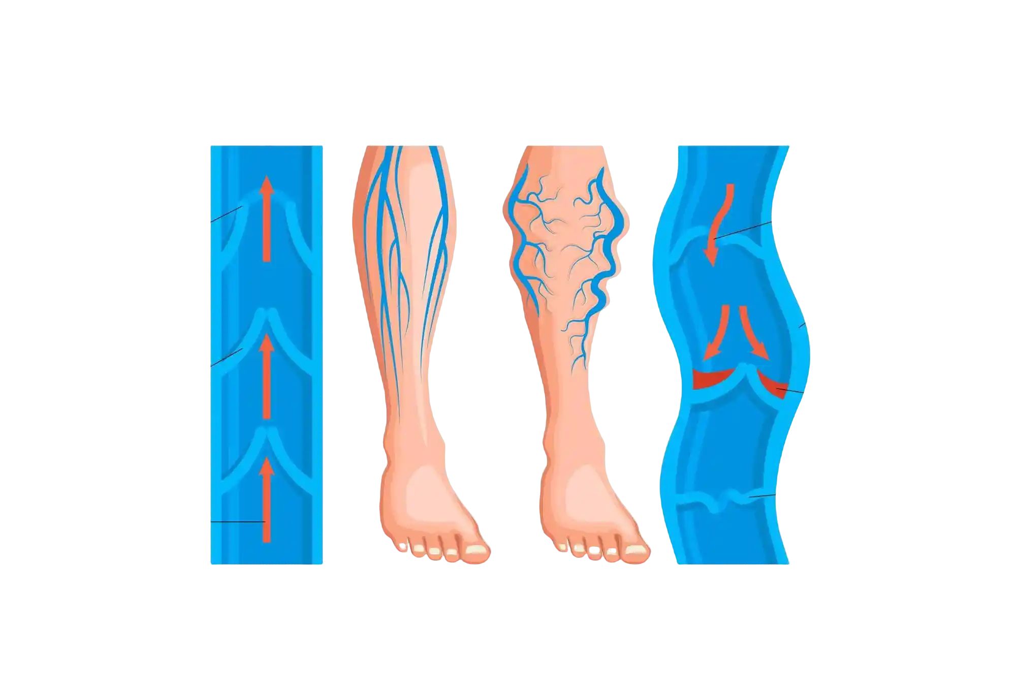 Varicose Veins Illustration
