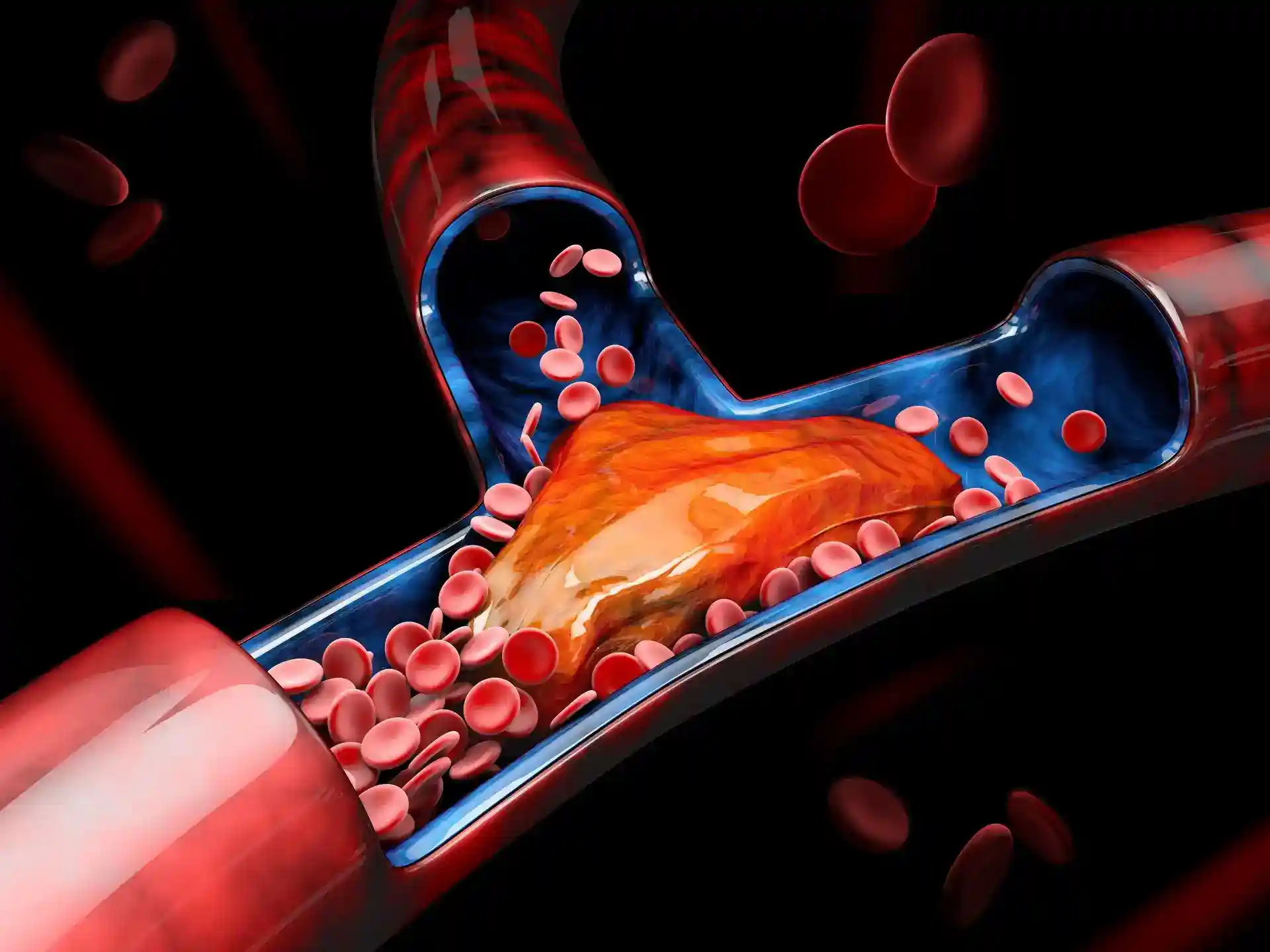 Venous Thrombosis Illustration