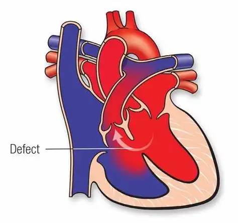 Ventricular Septal Defect Illustration